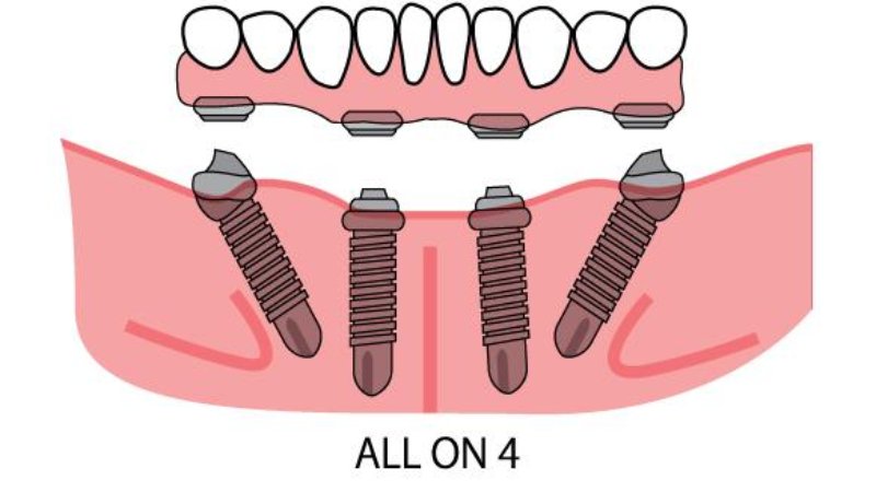All on 4 dental implants