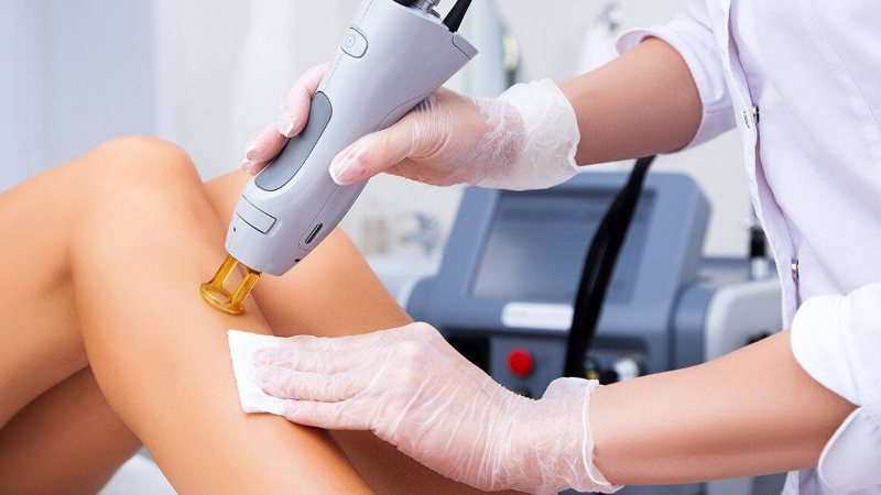 Laser Hair Removal